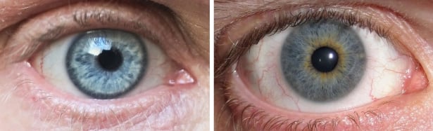 Grey eyes with or without a limbal ring